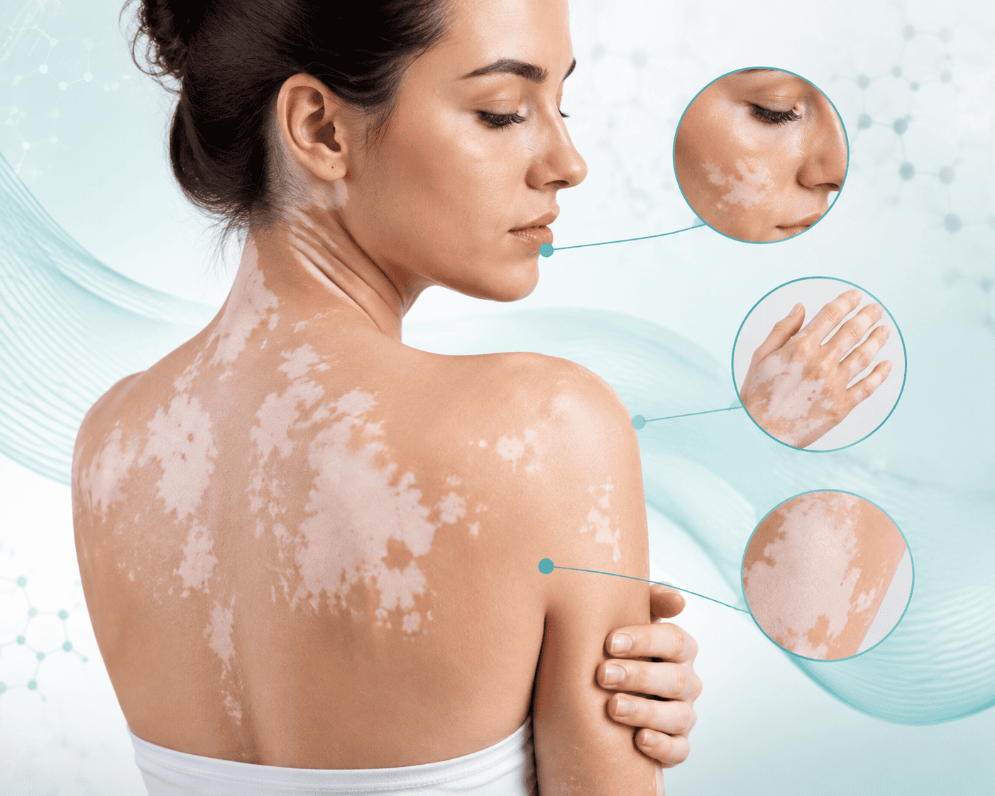 vitiligo simptomi